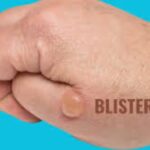 blisterata